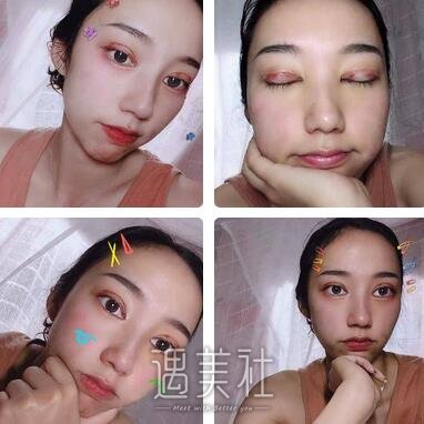省二院,张卓男,修复双眼皮