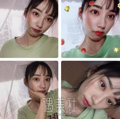 省二院,张卓男,修复双眼皮