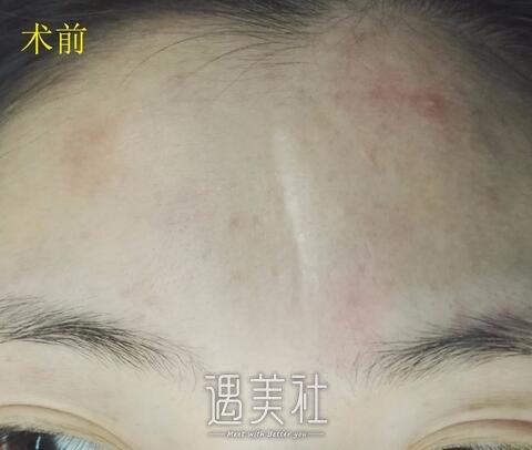 杨东运,疤痕切缝
