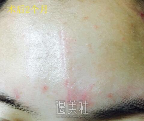 杨东运,疤痕切缝