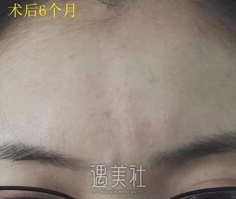 杨东运,疤痕切缝