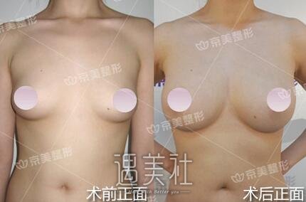 刘成胜,丰乳,李朕