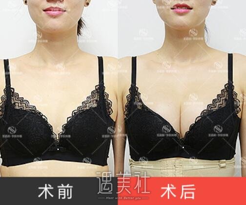 刘成胜,丰乳,李朕