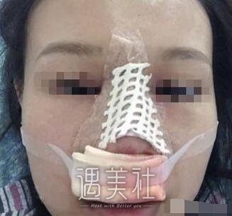 假体隆鼻