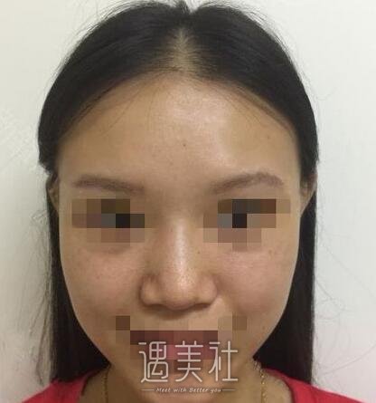 假体隆鼻