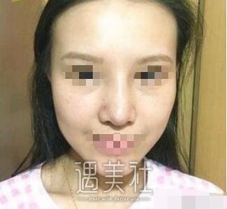 假体隆鼻