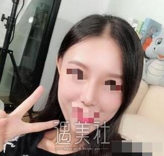 假体隆鼻