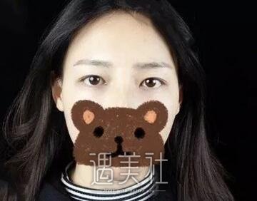 孙宝珊,双眼皮修复