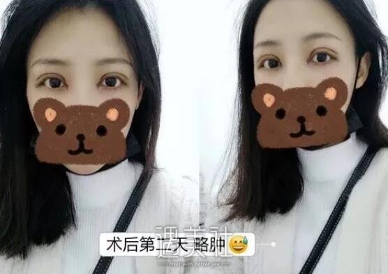 孙宝珊,双眼皮修复