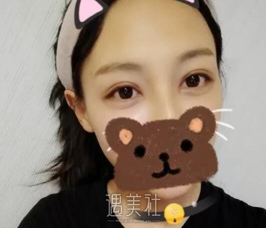 孙宝珊,双眼皮修复