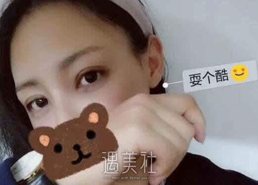 孙宝珊,双眼皮修复