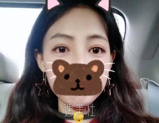 孙宝珊,双眼皮修复