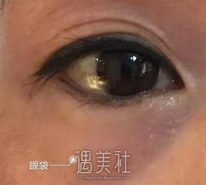 九院,濮哲铭,去眼袋