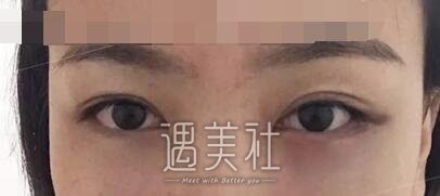 九院,濮哲铭,去眼袋