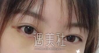 九院,濮哲铭,去眼袋