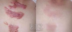 上海九院除疤怎么样?果好吗? width=