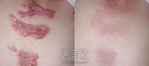 上海九院除疤怎么样?果好吗?