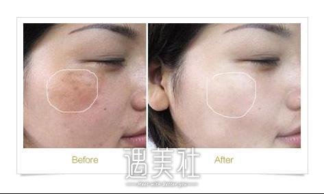 上海九院除疤怎么样?果好吗?