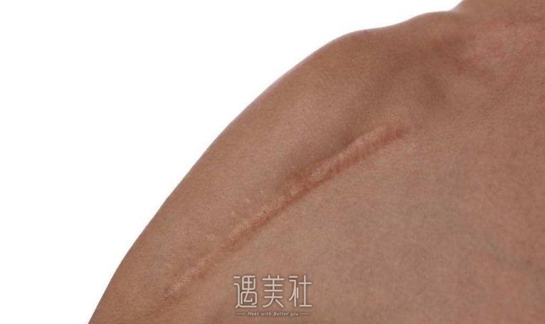 上海九院除疤怎么样?果好吗?