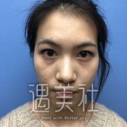 王琪影做的双眼皮案例果怎么样?我想要尝试一下~ width=