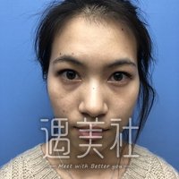 王琪影做的双眼皮案例果怎么样?我想要尝试一下~