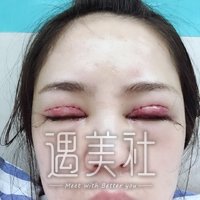王晋煌双眼皮技术好吗?真实案例一览~