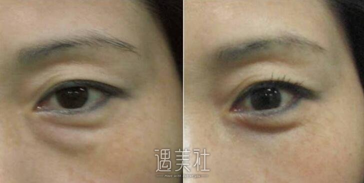 八大处医院整形价目表一览|去眼袋价格曝光!