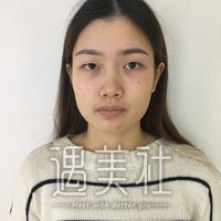 郑大二附院刘月丽双眼皮案例展示，果真自然~