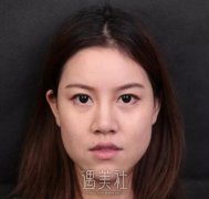 武汉亚太程晓林做鼻子技术怎么样?案例及果图一览~ width=