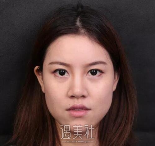 武汉亚太程晓林做鼻子技术怎么样?案例及果图一览~