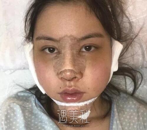 武汉亚太程晓林做鼻子技术怎么样?案例及果图一览~