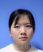 毕洪森面部吸脂技术有保障吗?相关案例展示~ width=
