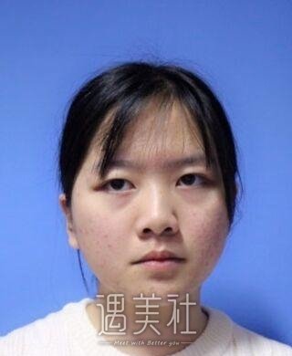 毕洪森面部吸脂技术有保障吗?相关案例展示~