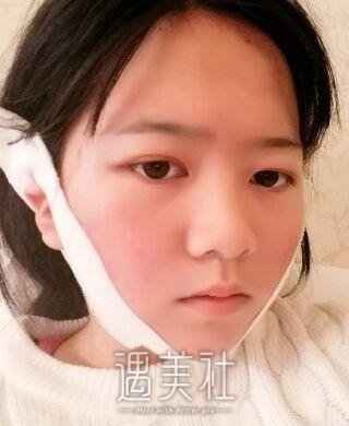 毕洪森面部吸脂技术有保障吗?相关案例展示~
