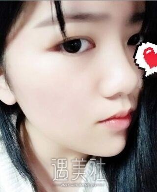 毕洪森面部吸脂技术有保障吗?相关案例展示~
