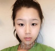 张卓男全切双眼皮案例：这双眼皮才叫惊艳！ width=