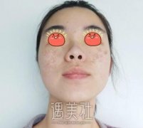 淄博一美整形美容医院祛斑怎么样？有案例吗？ width=