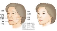 脂肪填充几天消肿看出形状？恢复期多久呢？ width=