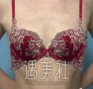 整形医生石蕾做丰胸案例：穿衣终于有料了！ width=