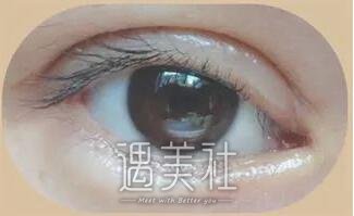 割双眼皮