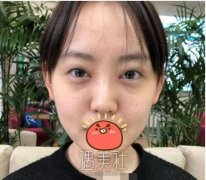 浙二薛旦双眼皮案例：睁眼有神闭眼微创 width=