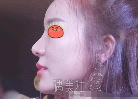 上海,pro,鼻部手术