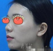 上海pro网红整形鼻部手术案例  顺便还做了个下巴 width=
