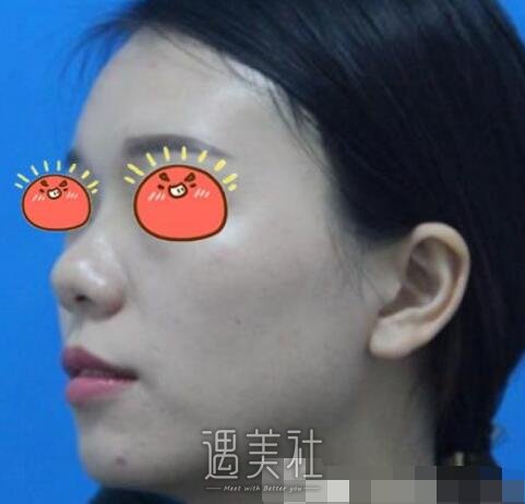上海,pro,鼻部手术