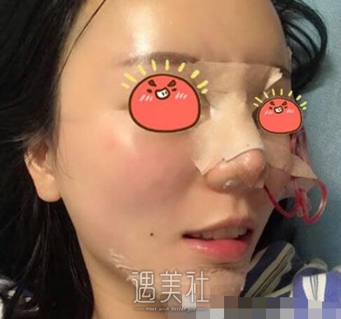 上海,pro,鼻部手术