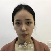 田孝臣隆鼻案例,6个月过去了来谈点个人体会 width=