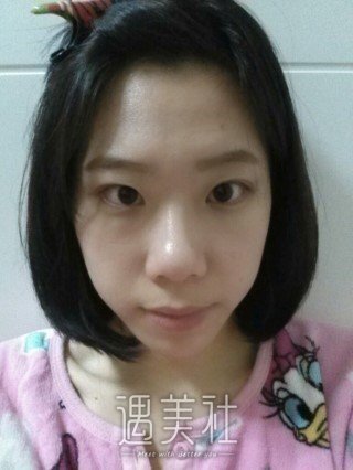 贾大辉做鼻子怎么样?案例及果图一览~