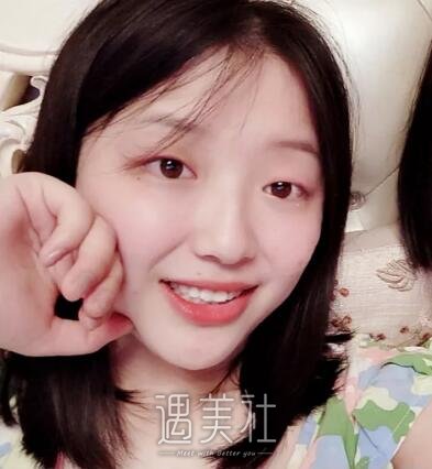 西安孙峰双眼皮案例分享|术后实时记录~