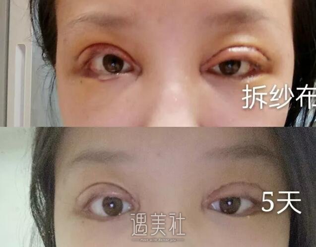 西安孙峰双眼皮案例分享|术后实时记录~
