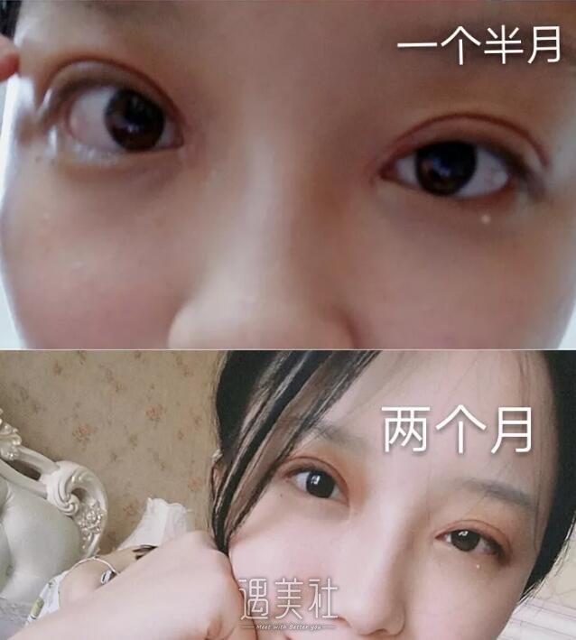 西安孙峰双眼皮案例分享|术后实时记录~